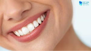 chi-phi-dan-su-veneer-tai-nha-trang